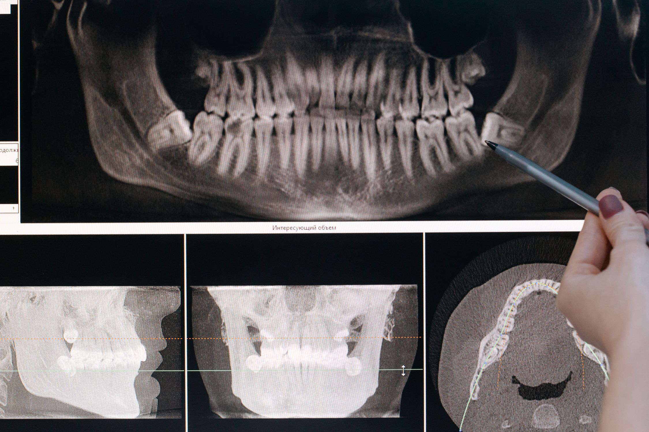 Radiografía panorámica dental utilizada para el diagnóstico